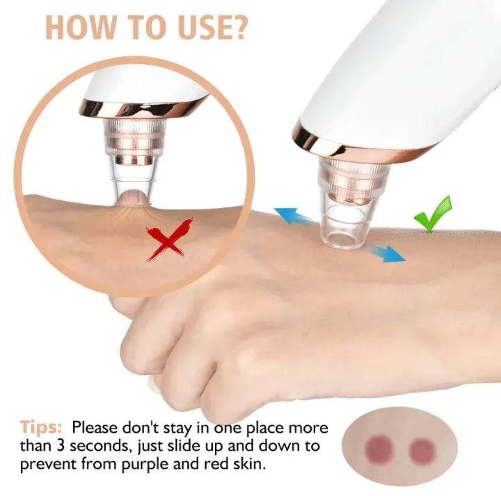 Acne Pore Cleaner & Black Head Remover - Vora