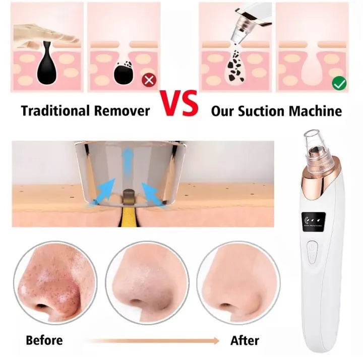 Acne Pore Cleaner & Black Head Remover - Vora