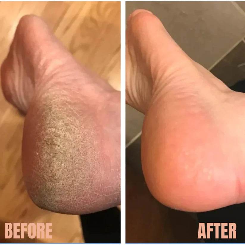 USB Foot Grinding Machine - Foot Care - Vora