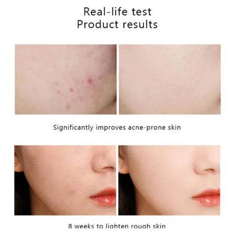 The Ordinary Niacinamide 10% + Zinc 1% Serum - Vora